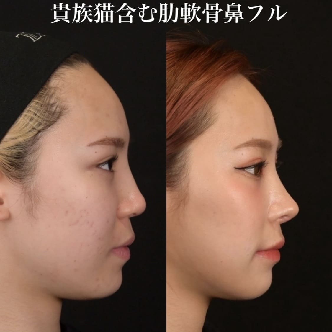 鉄医師による鼻整形の術前/術後3ヶ月 施術後 