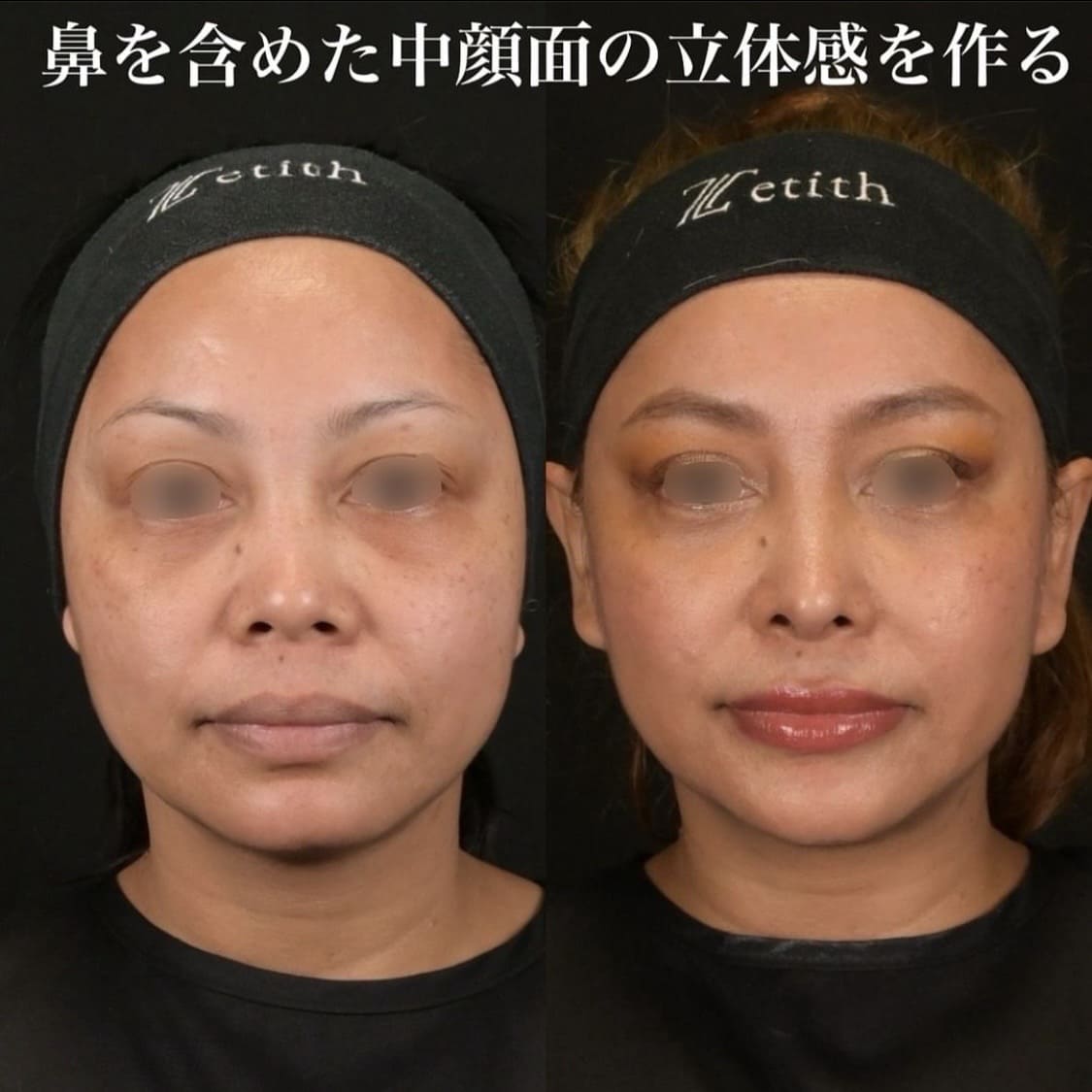 鉄医師による鼻整形の術前/術後6ヶ月
