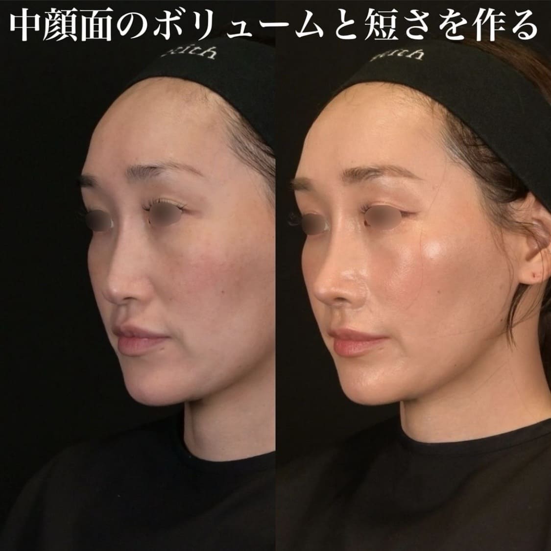 鉄医師による鼻整形の術前/術後1ヶ月