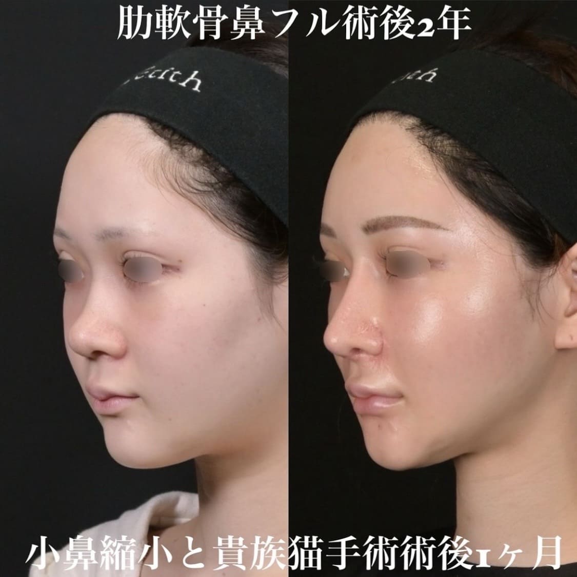 鉄医師による鼻整形の術前/術後２年 术后 