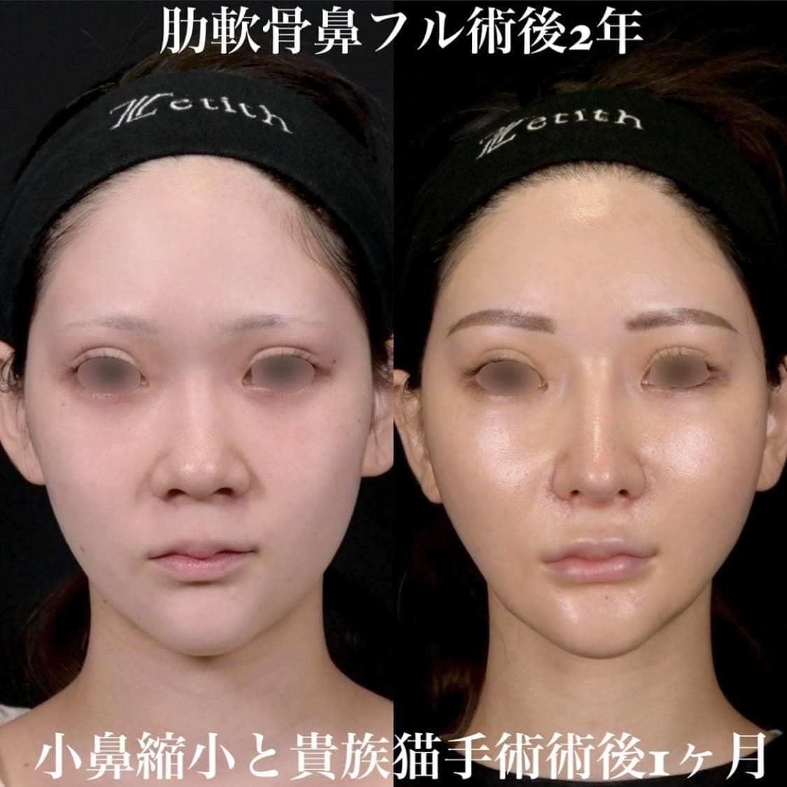 鉄医師による鼻整形の術前/術後２年