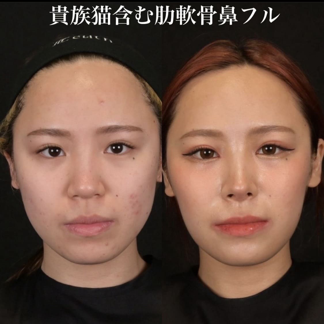 鉄医師による鼻整形の術前/術後3ヶ月