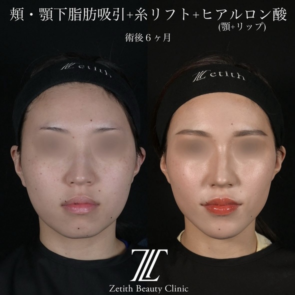 北村医師による脂肪吸引リフトの術前/術後6ヶ月