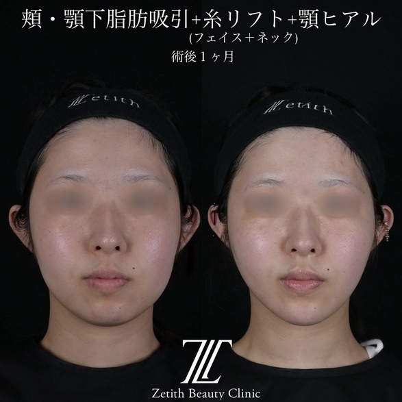 北村医師による脂肪吸引リフトの術前/術後1ヶ月