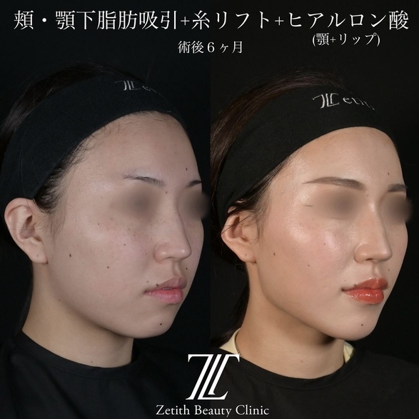 北村医師による脂肪吸引リフトの術前/術後6ヶ月 施術後 