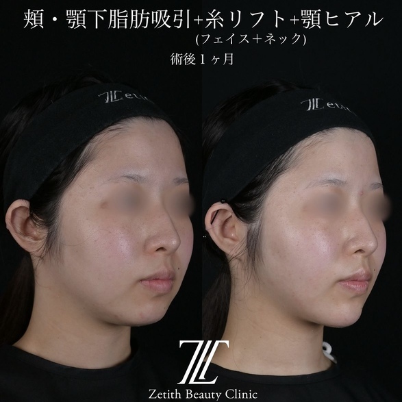 北村医師による脂肪吸引リフトの術前/術後1ヶ月 Sonra 