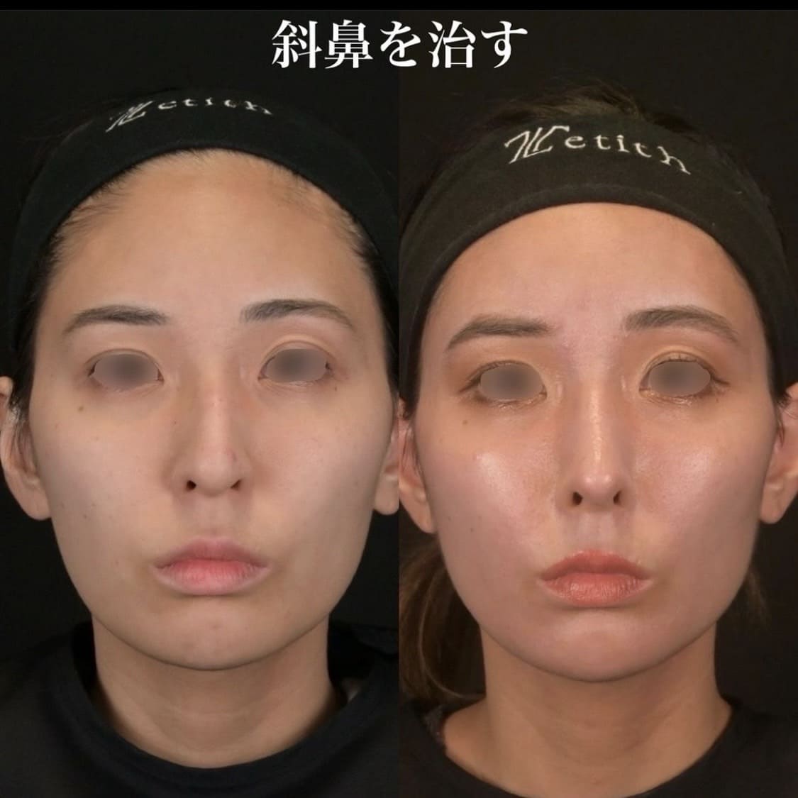 鉄医師による鼻整形の術前/術後3ヶ月 施術後 