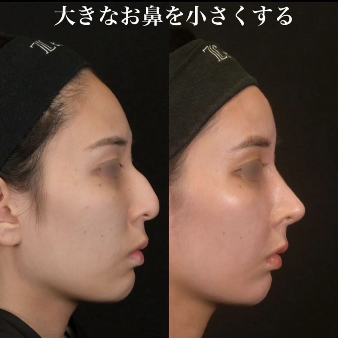 鉄医師による鼻整形の術前/術後3ヶ月