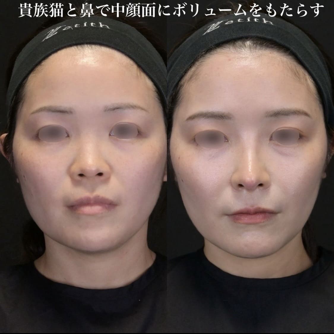 鉄医師による鼻整形の術前/術後1ヶ月 施術後 