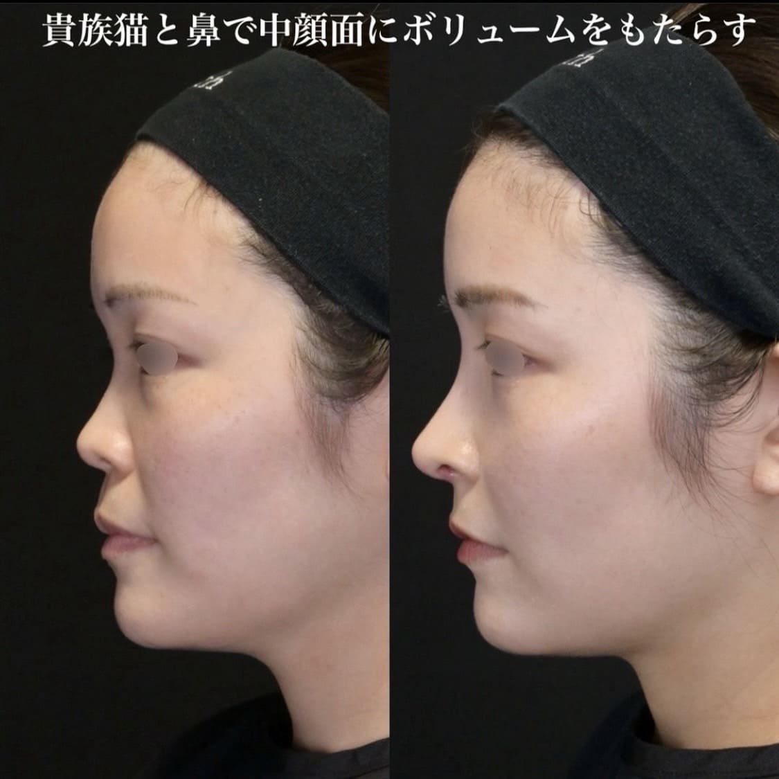 鉄医師による鼻整形の術前/術後1ヶ月