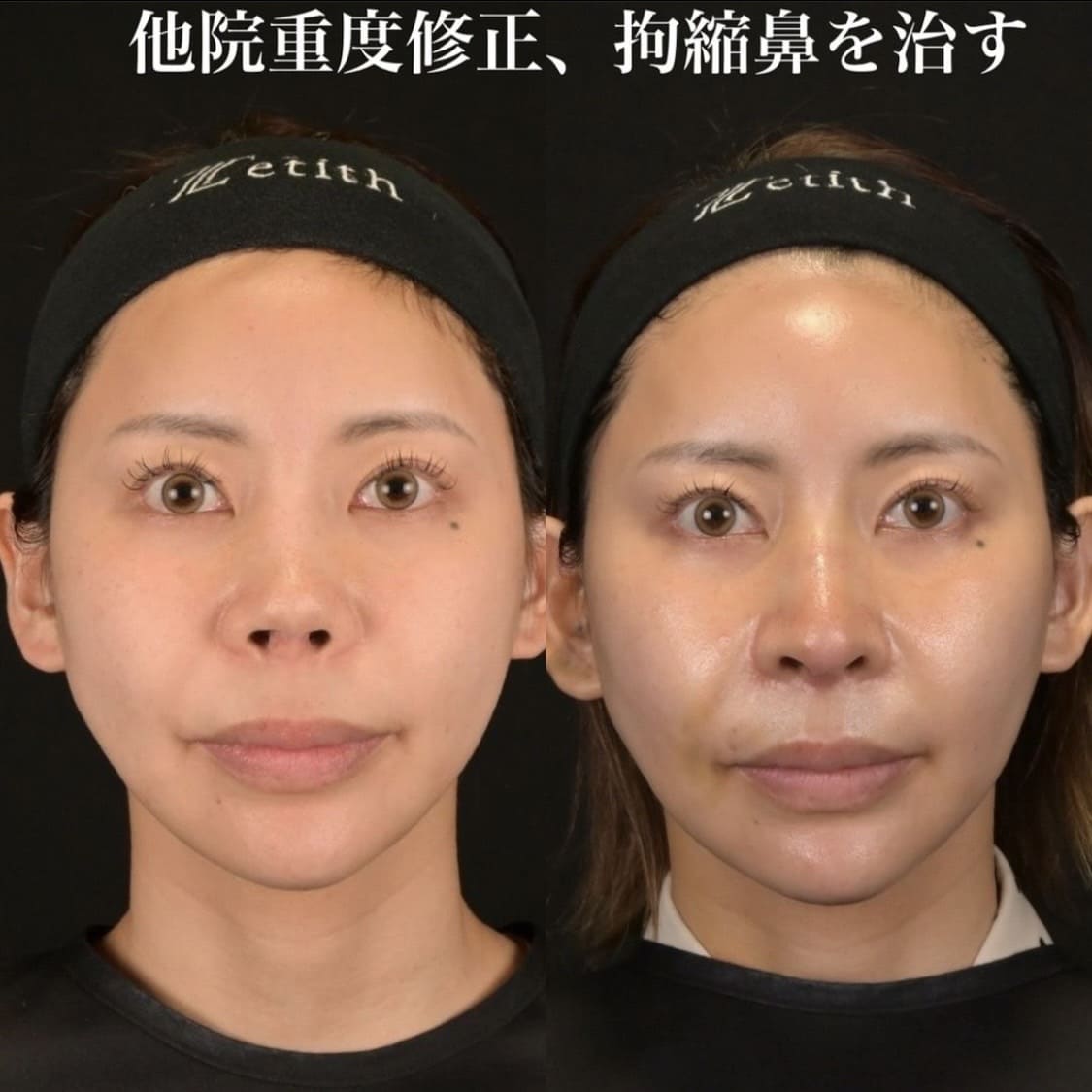 鉄医師による鼻整形の術前/術後1ヶ月