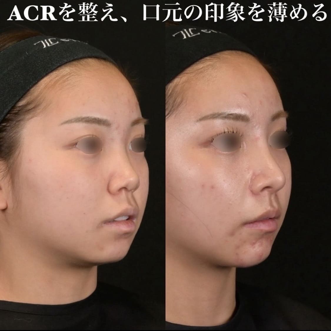 鉄医師による鼻整形の術前/術後6ヶ月 施術後 