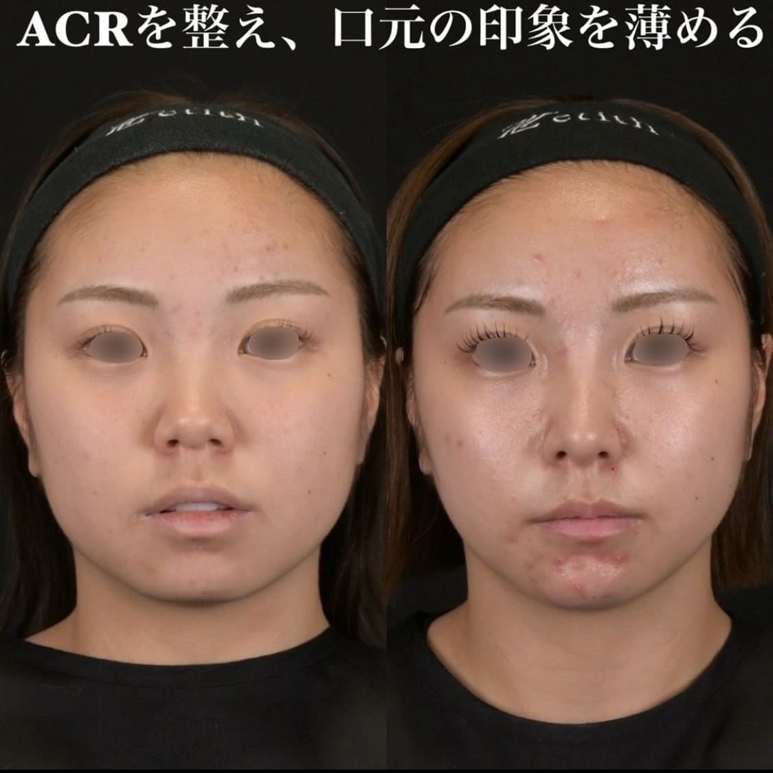 鉄医師による鼻整形の術前/術後6ヶ月
