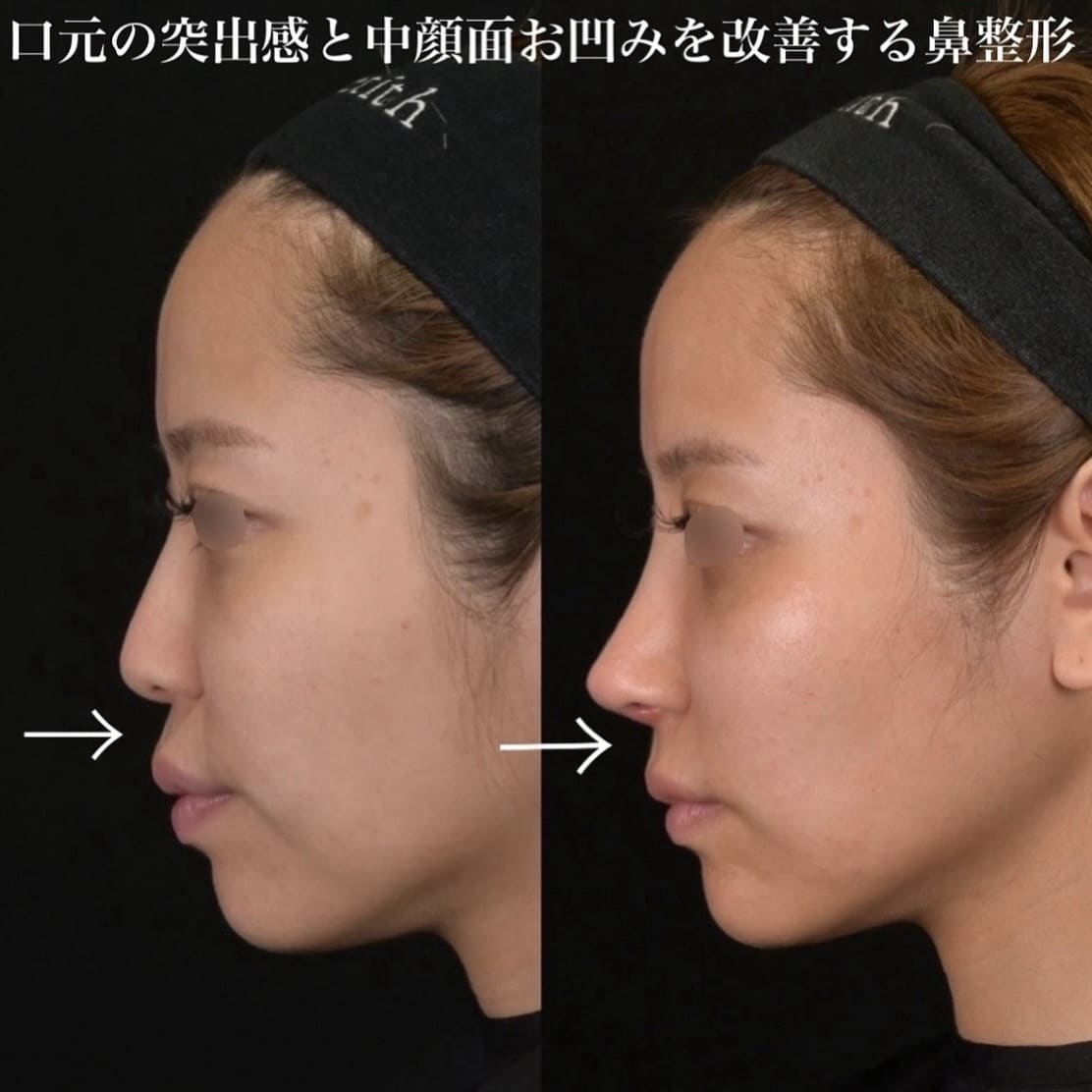 鉄医師による鼻整形の術前/術後1ヶ月 施術後 