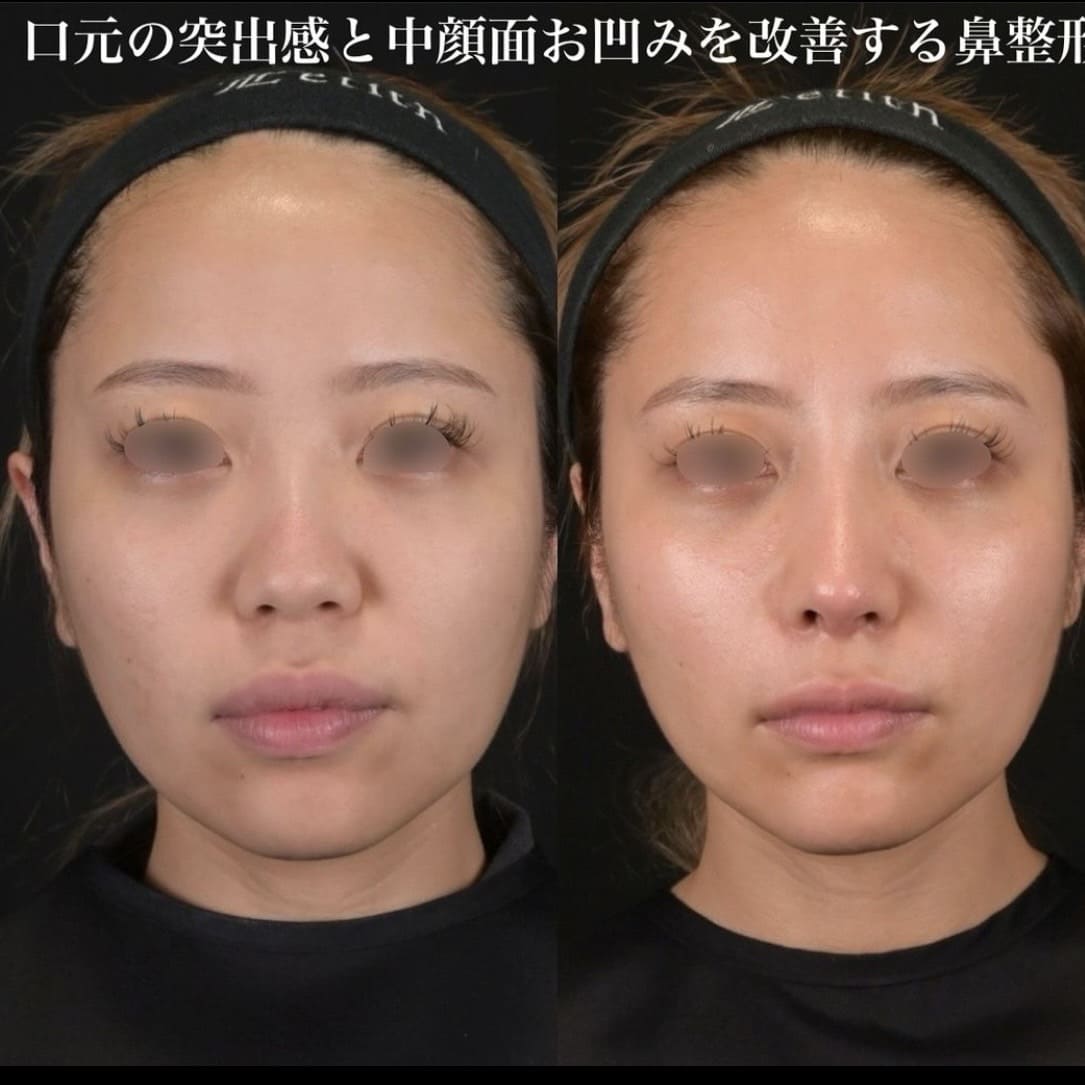鉄医師による鼻整形の術前/術後1ヶ月