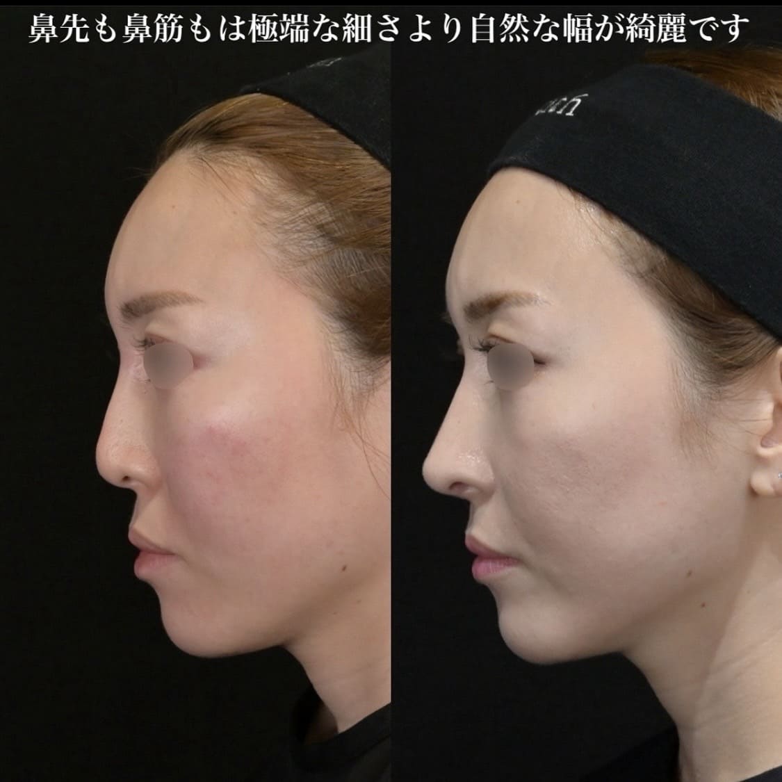 鉄医師による鼻整形の術前/術後6ヶ月 施術後 