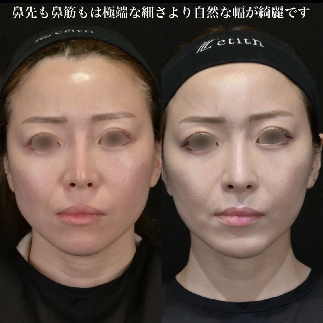 鉄医師による鼻整形の術前/術後6ヶ月