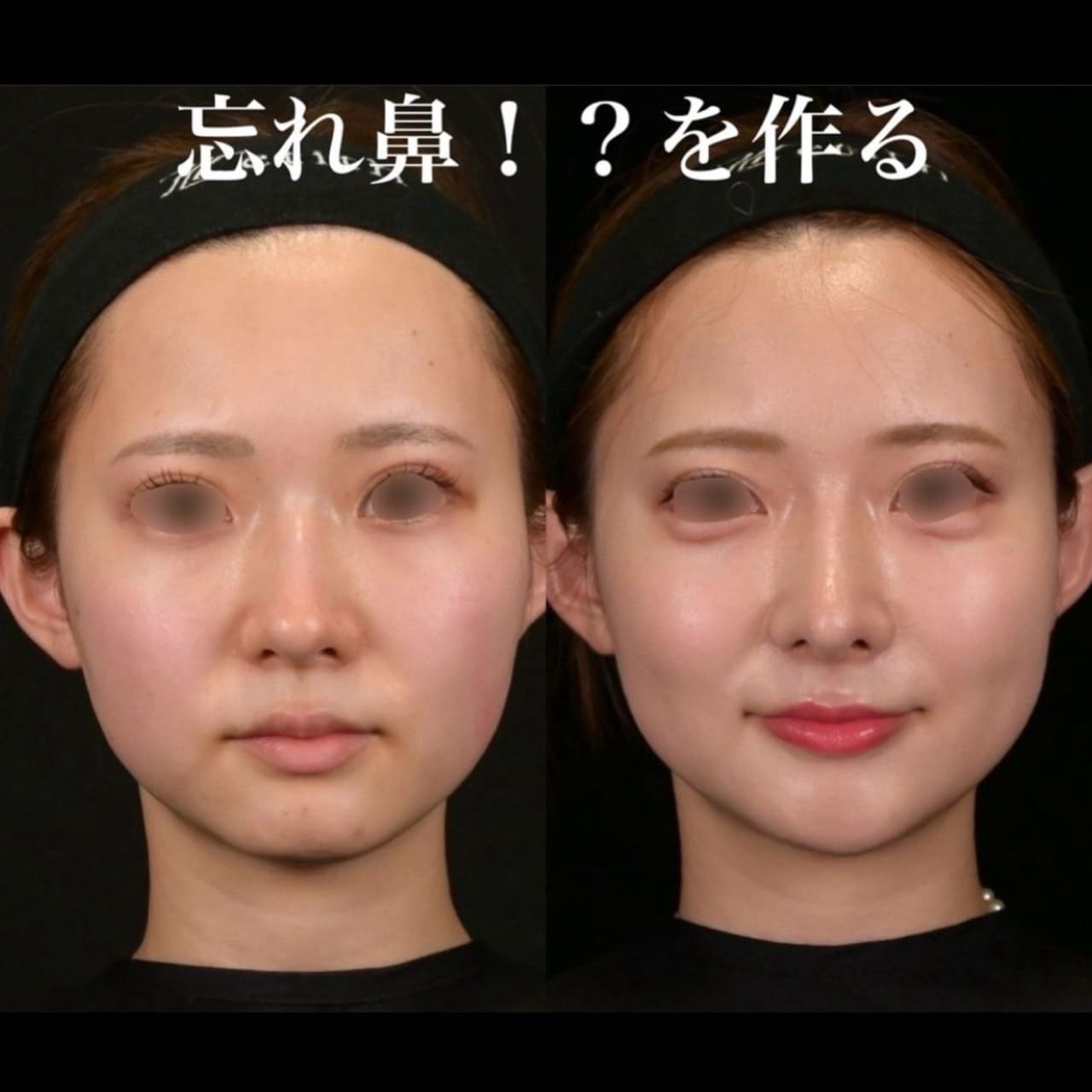 鉄医師による鼻整形の術前/術後6ヶ月
