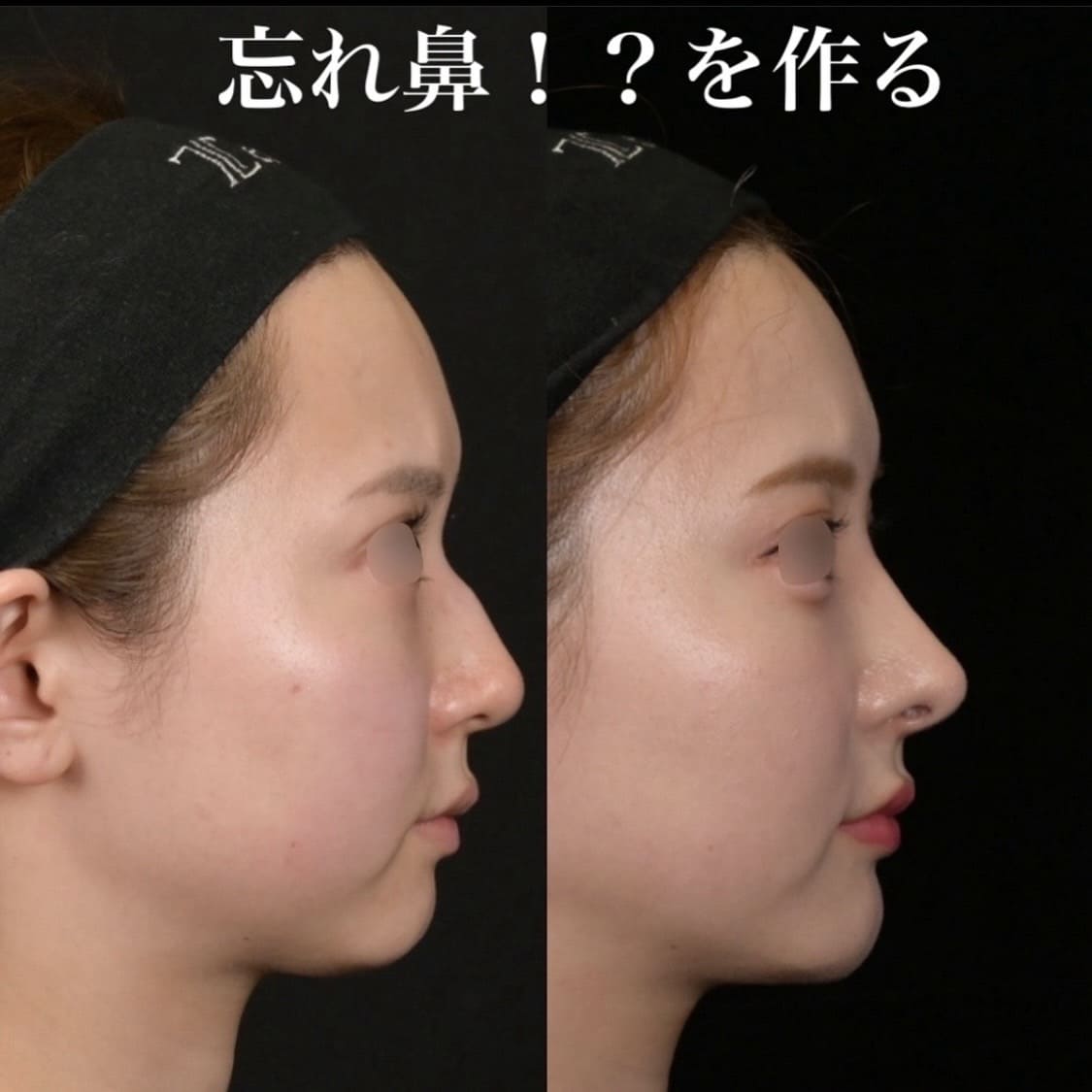 鉄医師による鼻整形の術前/術後6ヶ月 术后 