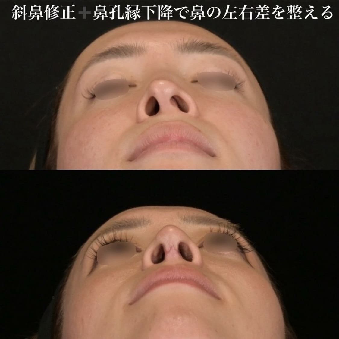 鉄医師による鼻整形の術前/術後３ヶ月