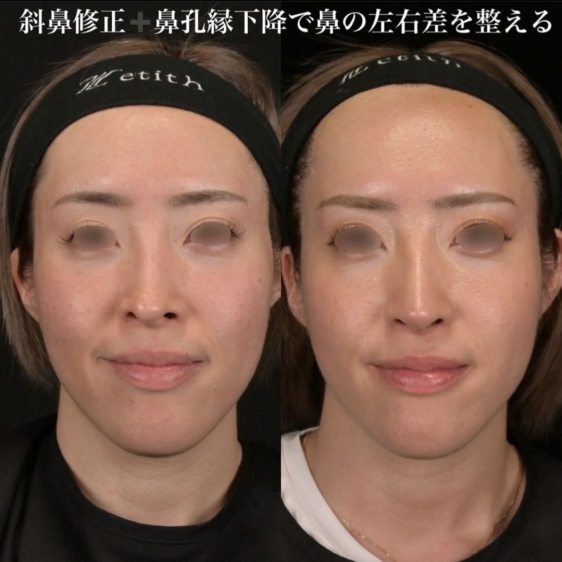 鉄医師による鼻整形の術前/術後３ヶ月 หลัง 