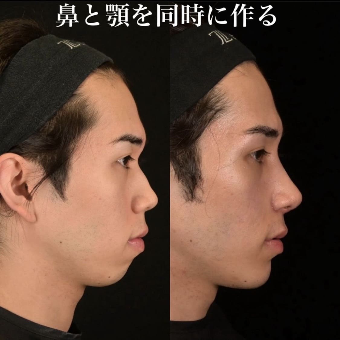 鉄医師による鼻整形の術前/術後２週間 施術後 