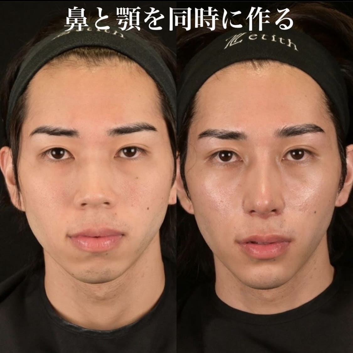 鉄医師による鼻整形の術前/術後２週間