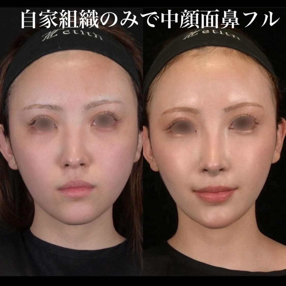 鉄医師による鼻整形の術前/術後３ヶ月 Дараа 