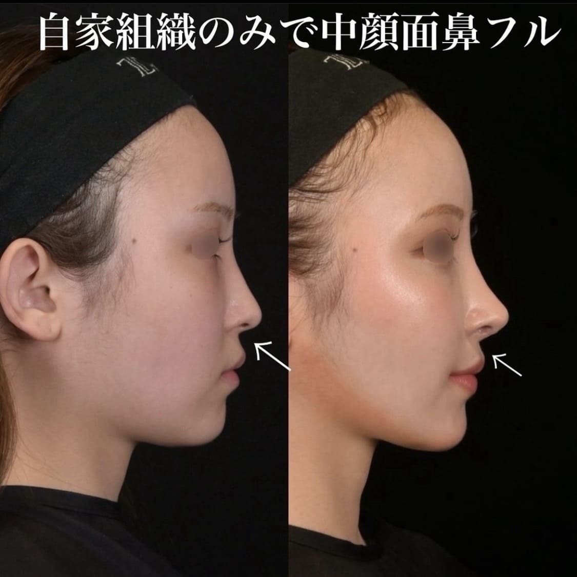 鉄医師による鼻整形の術前/術後３ヶ月