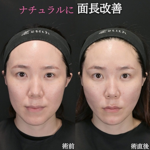 沈医師による糸リフトの術前/術直後