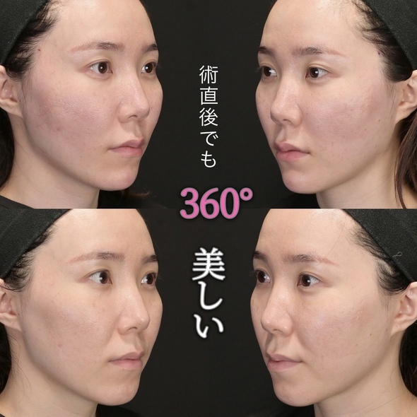 沈医師による糸リフトの術前/術直後 Дараа 