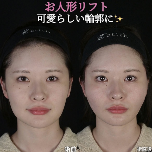沈医師による糸リフトの術前/術直後