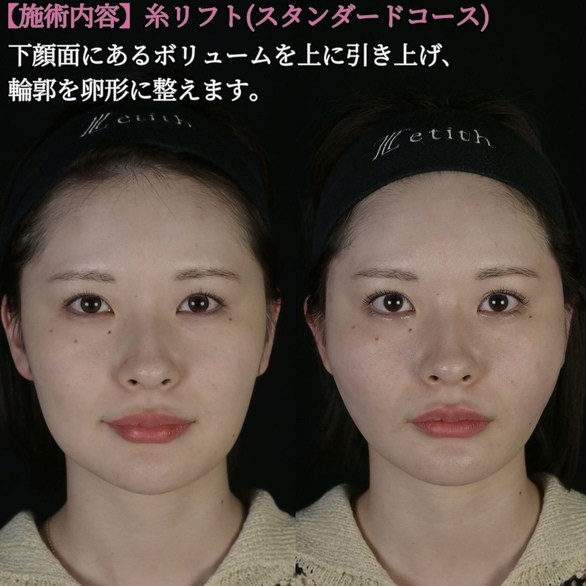 沈医師による糸リフトの術前/術直後 施術後 