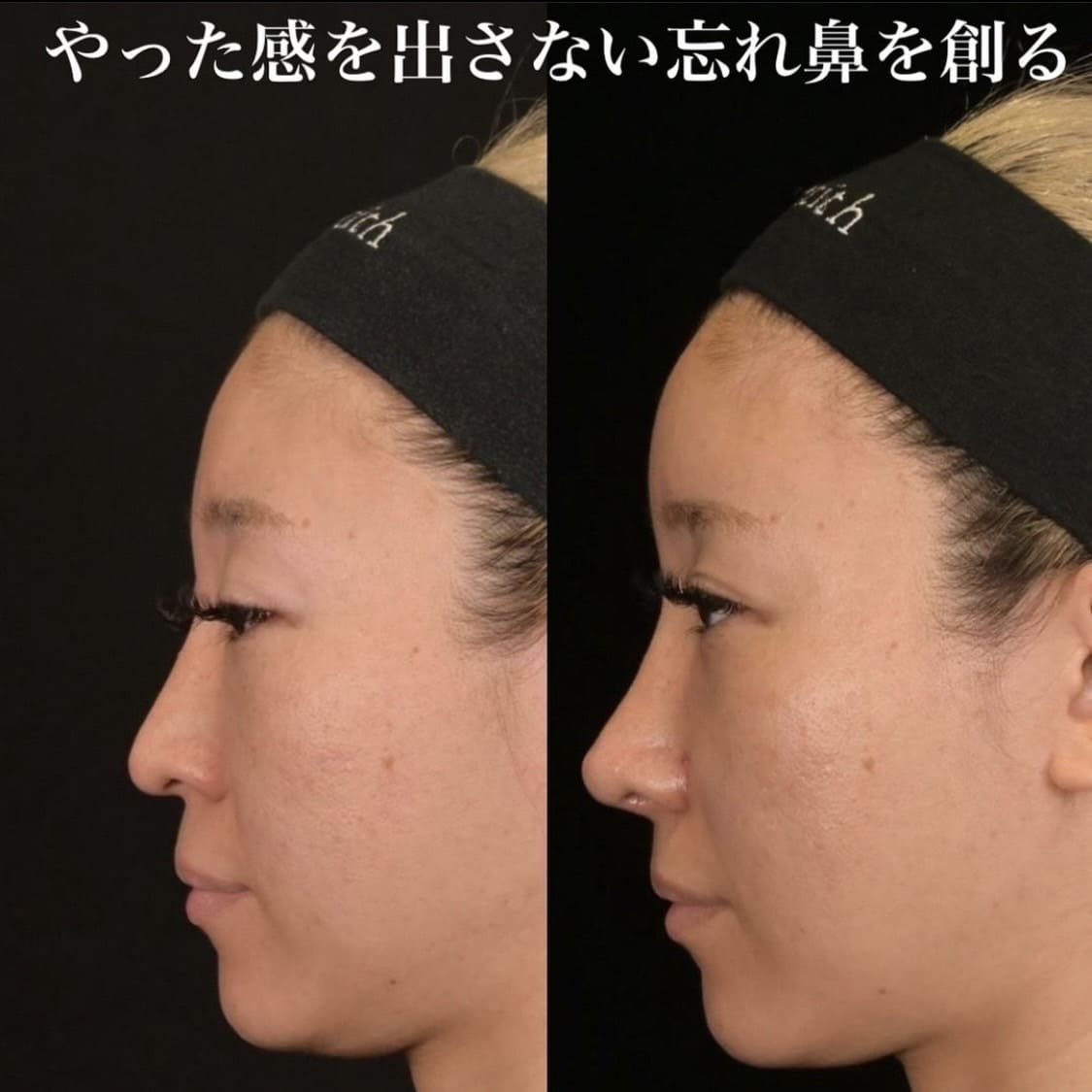 鉄医師による鼻整形の術前/術後1ヶ月 After 