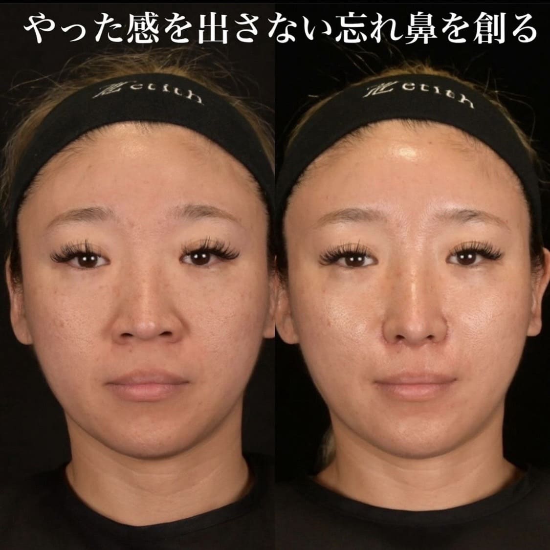 鉄医師による鼻整形の術前/術後1ヶ月