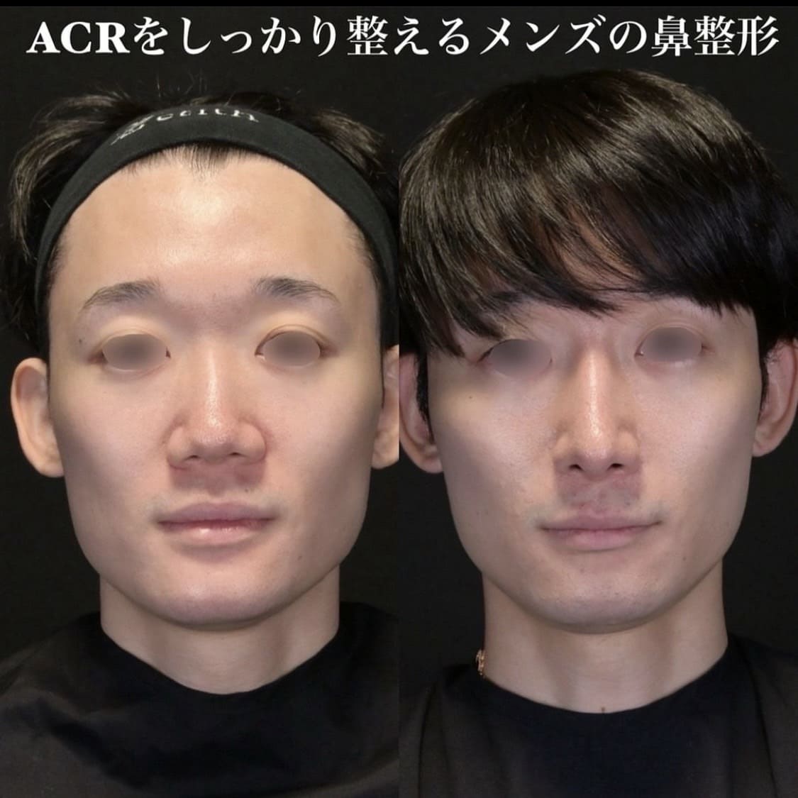鉄医師による鼻整形の術前/術後6ヶ月