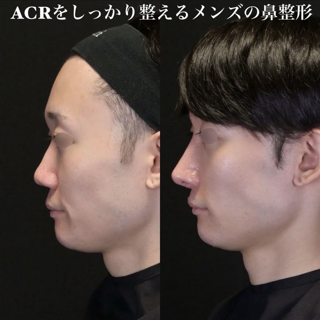 鉄医師による鼻整形の術前/術後6ヶ月 术后 