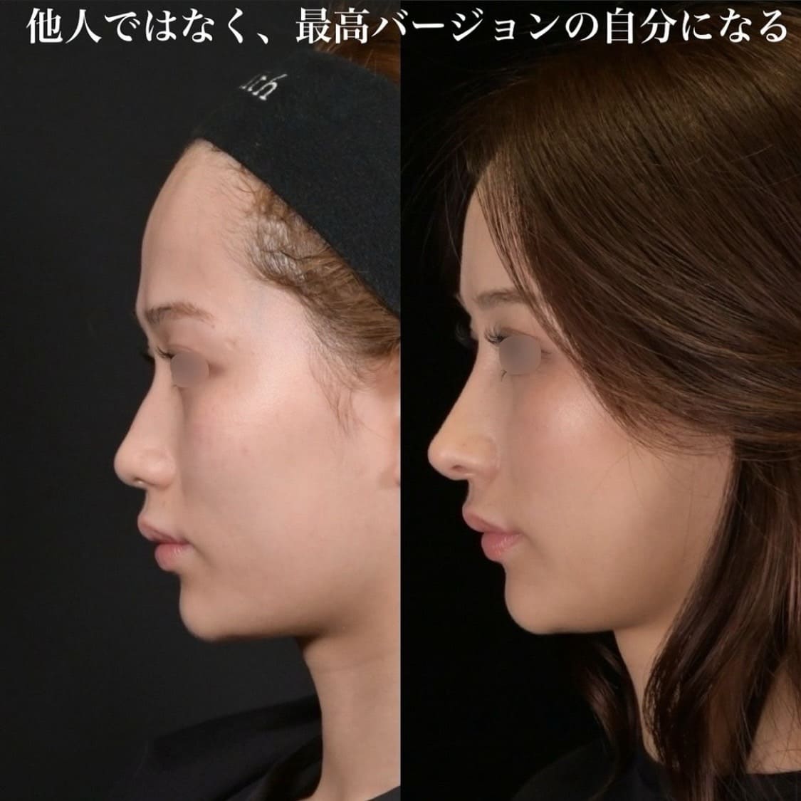 鉄医師による鼻整形の術前/術後1年半 施術後 