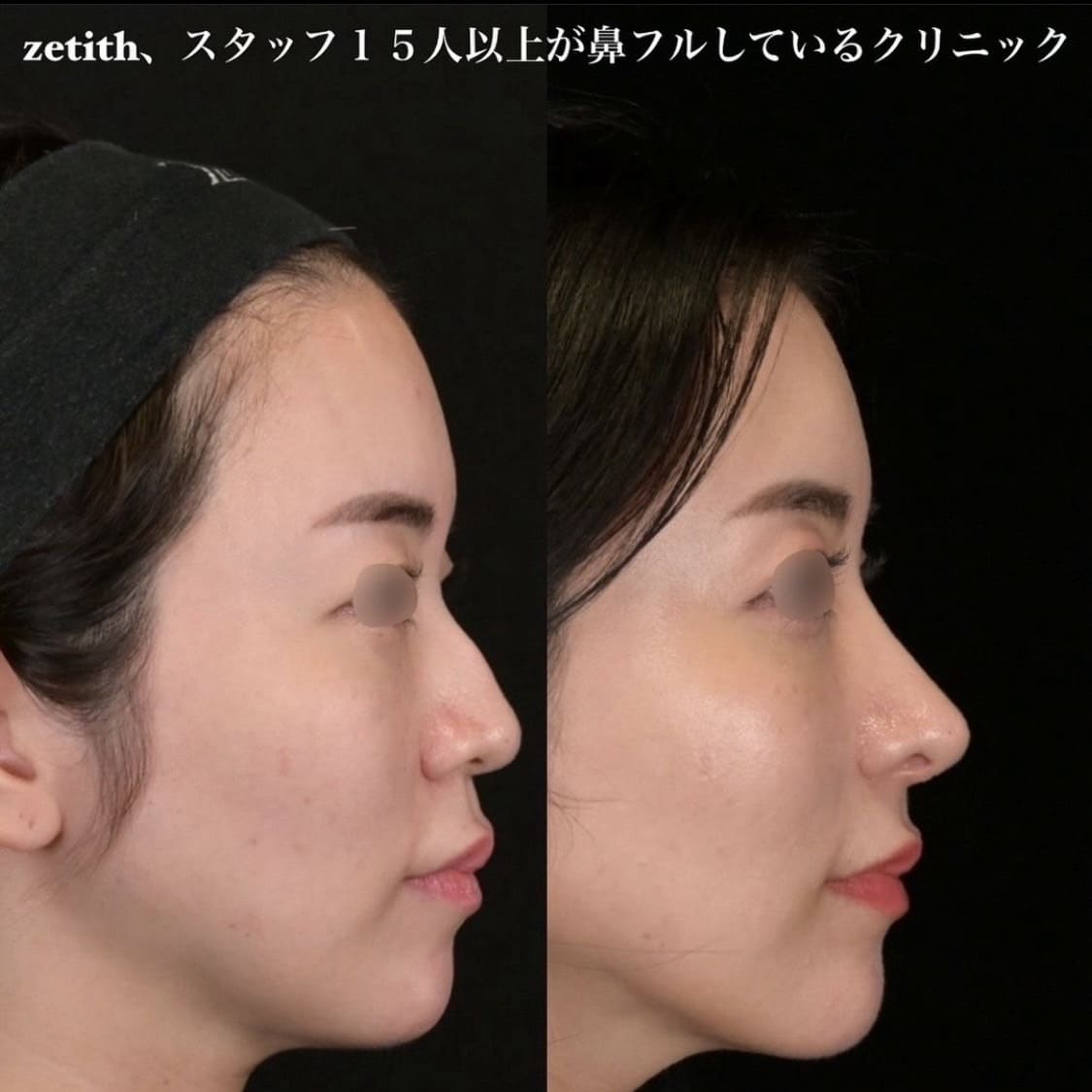鉄医師による鼻整形の術前/術後３ヶ月 术后 