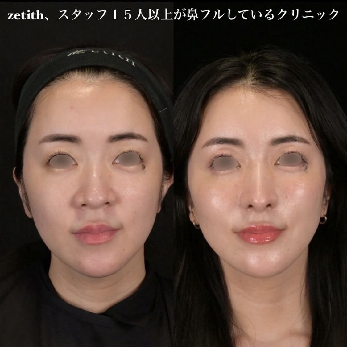 鉄医師による鼻整形の術前/術後３ヶ月