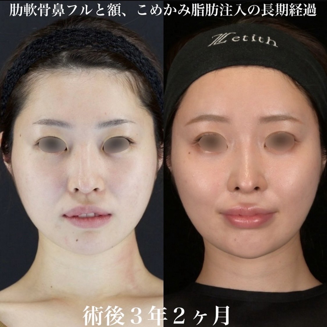 鉄医師による鼻整形の術前/術後3年2ヶ月 施術後 