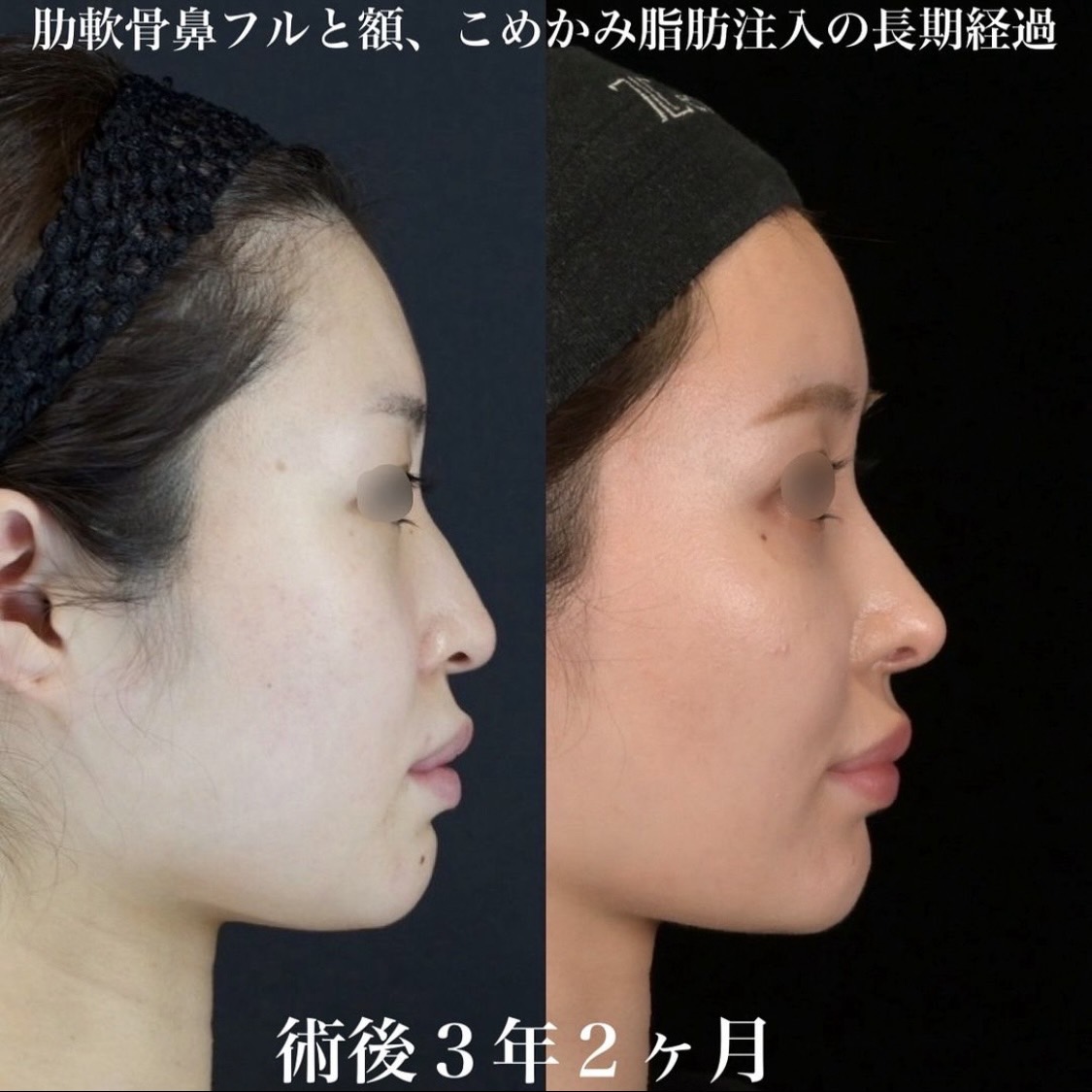鉄医師による鼻整形の術前/術後3年2ヶ月