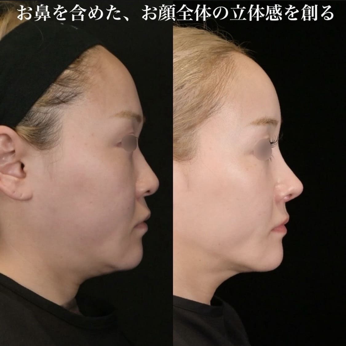 鉄医師による鼻整形の術前/術後4ヶ月