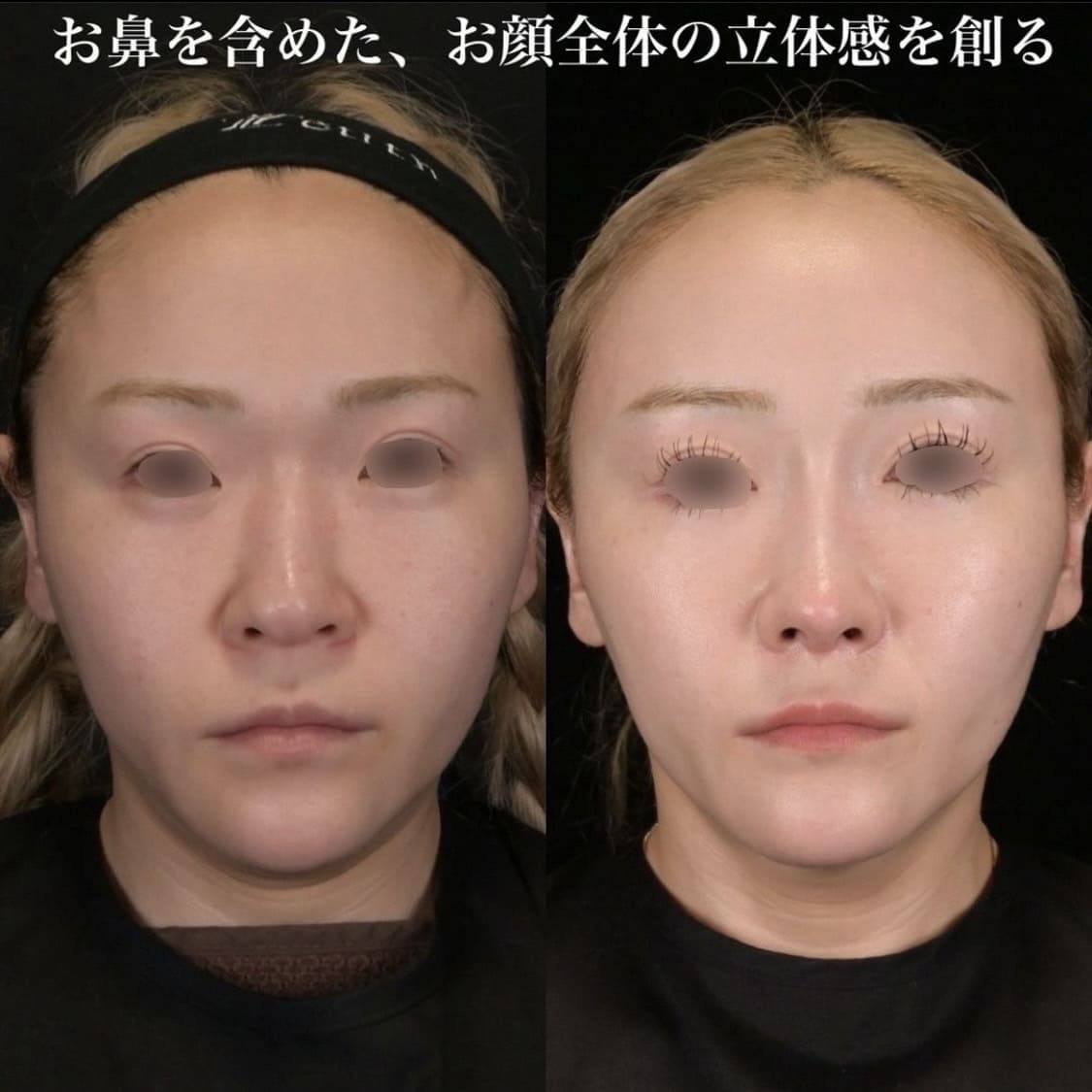 鉄医師による鼻整形の術前/術後4ヶ月 施術後 