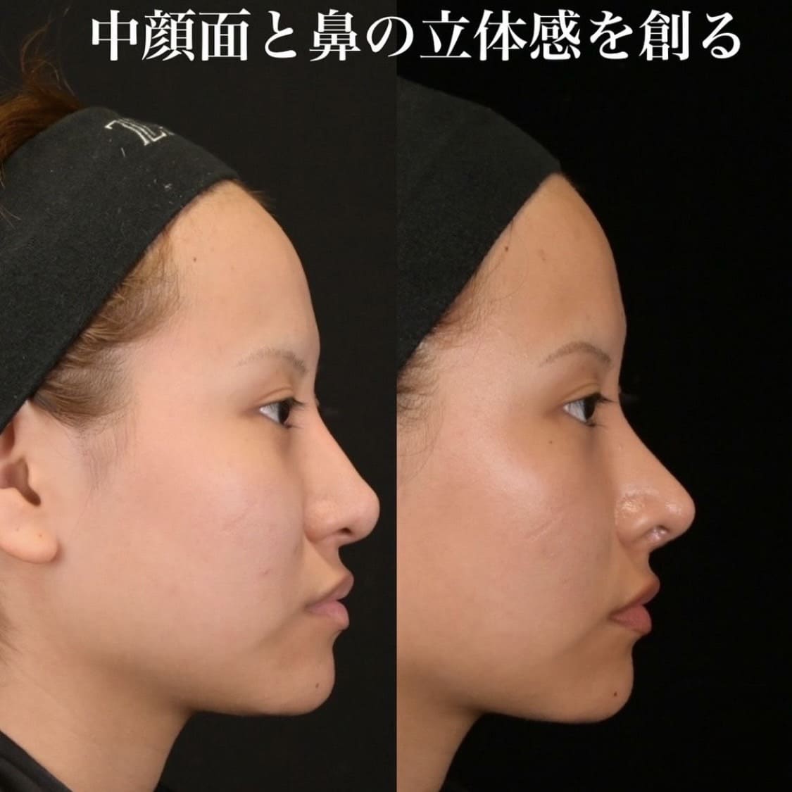 鉄医師による鼻整形の術前/術後1ヶ月