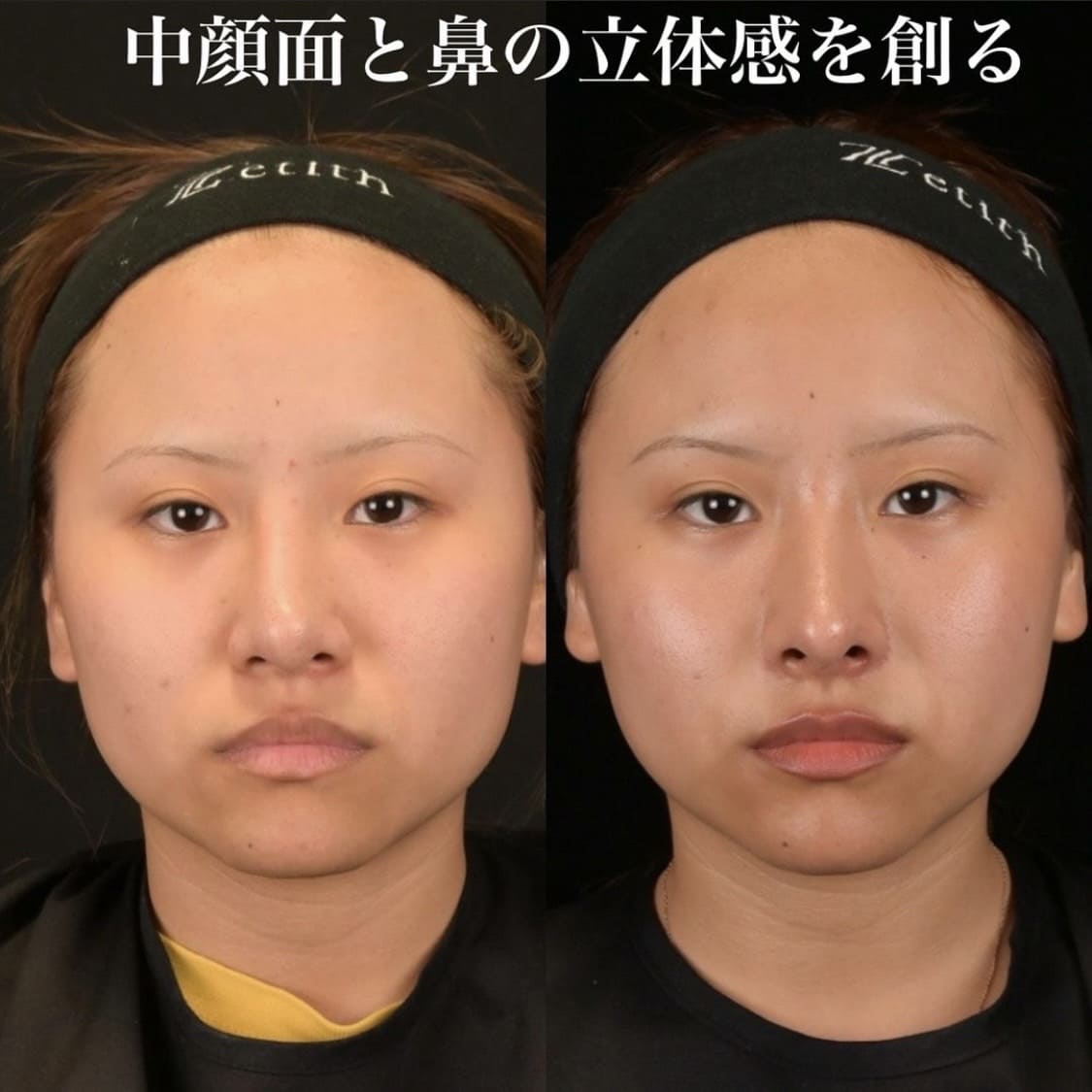 鉄医師による鼻整形の術前/術後1ヶ月 หลัง 