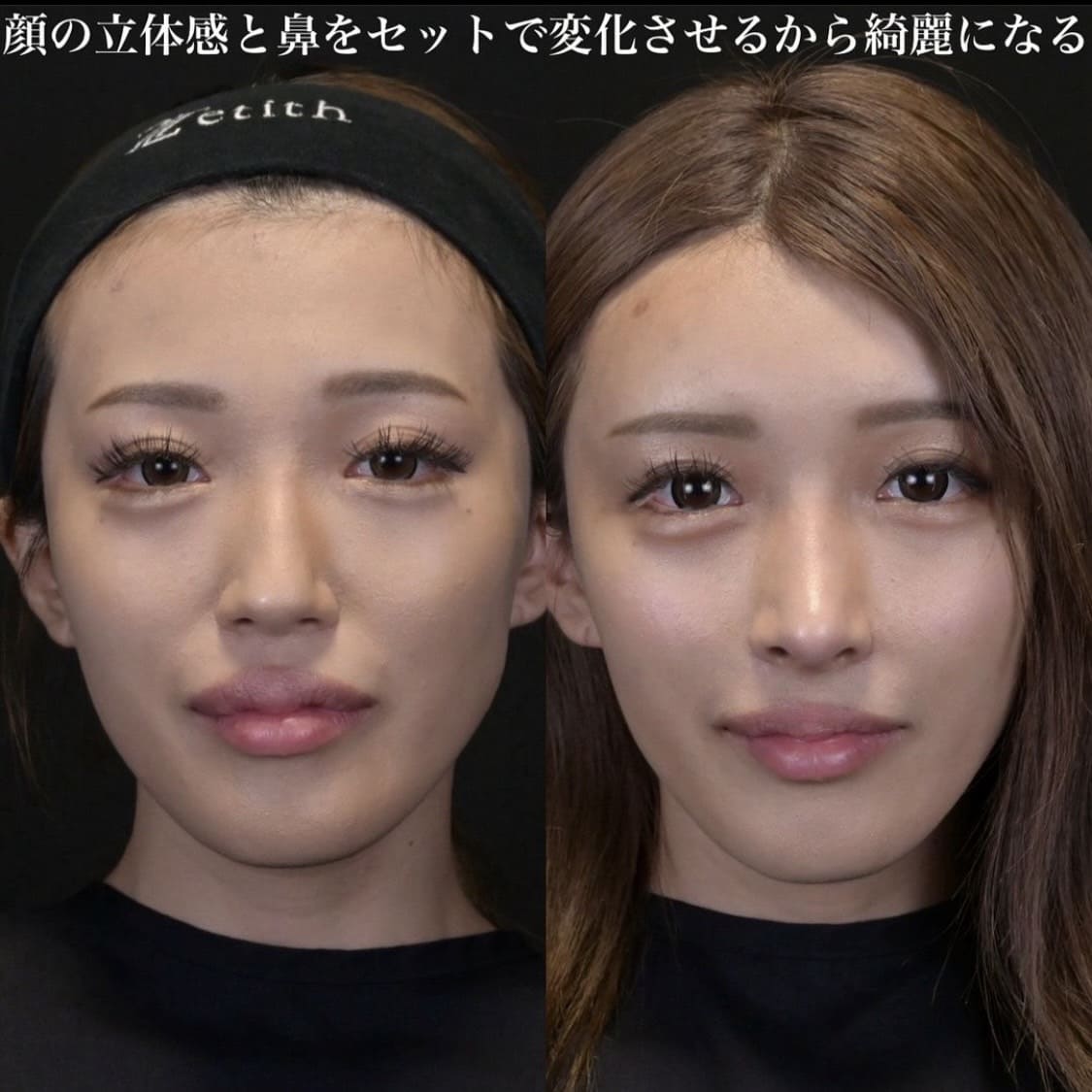 鉄医師による鼻整形の術前/術後1ヶ月 After 
