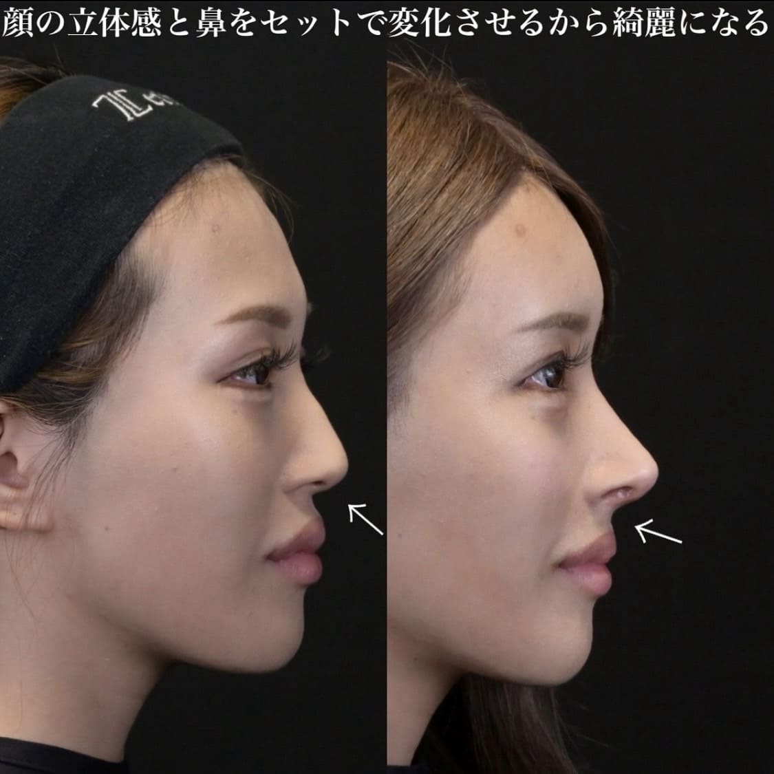 鉄医師による鼻整形の術前/術後1ヶ月