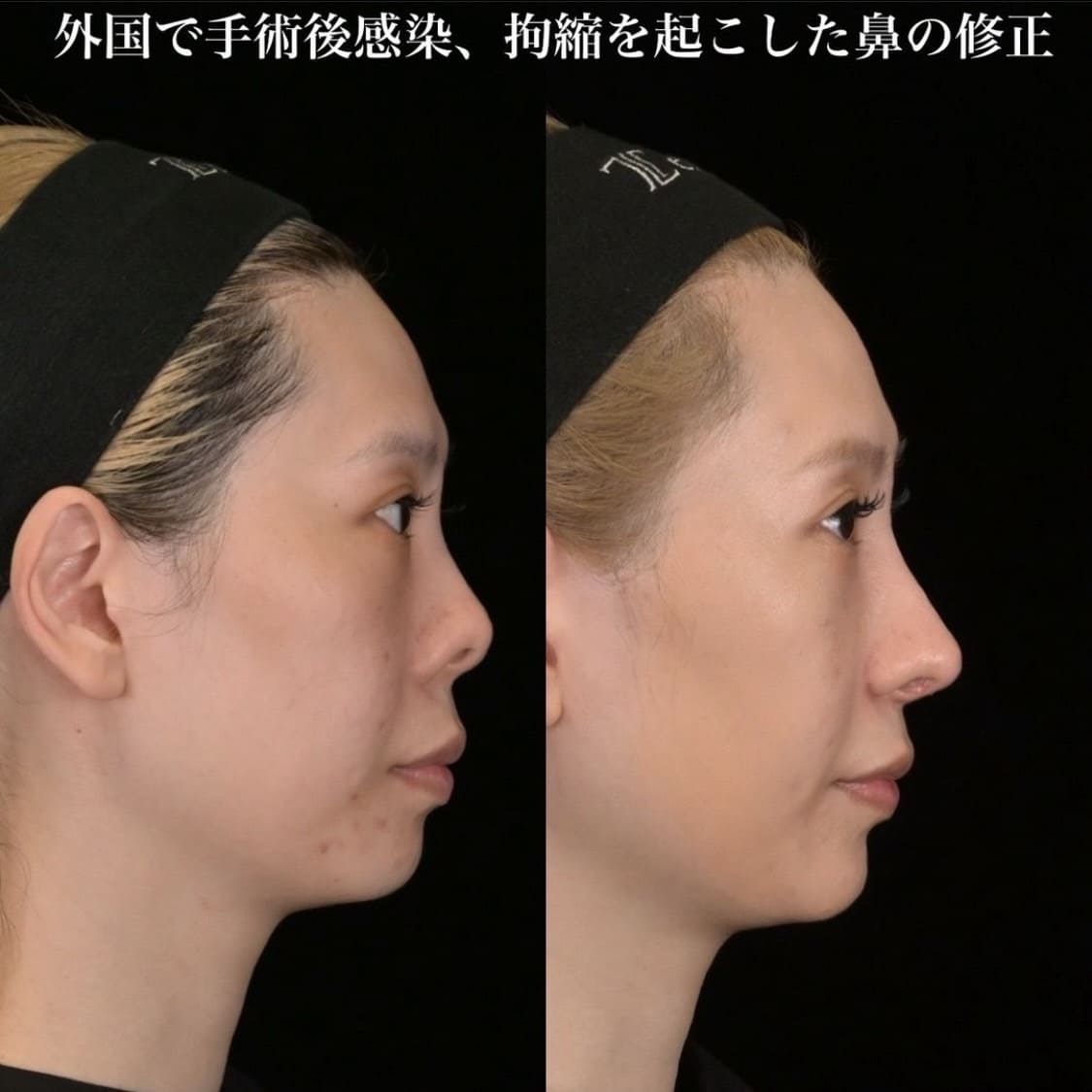 鉄医師による鼻整形の術前/術後1ヶ月