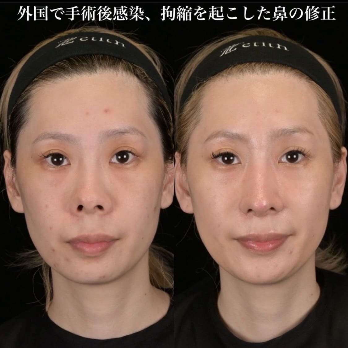 鉄医師による鼻整形の術前/術後1ヶ月 施術後 